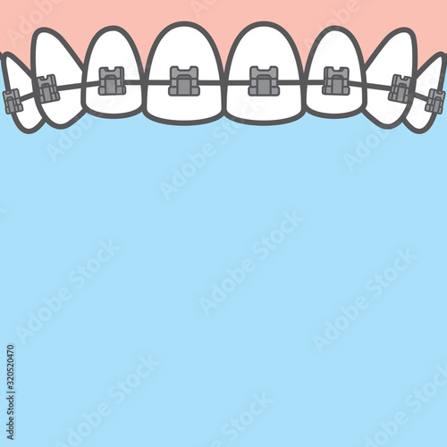 Blank banner metal braces (upper) teeth illustration vector on blue background. Dental concept.