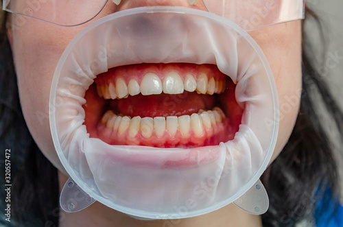 Teeth in the mouth at the dental clinic, the mouth is opened with a cheek retractor.