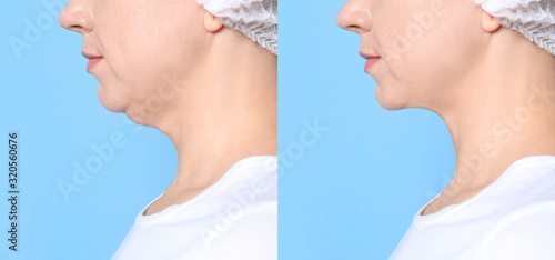 Obraz na plátně Mature woman before and after plastic surgery operation on blue background, closeup