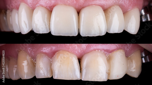 before and after picture for press ceramic crowns