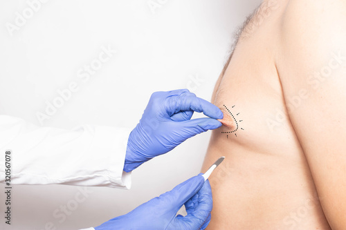 Dotkor plastic surgeon examines the nipples in the male patient for surgery to correct and change the shape of the nipple, anaplasty photo