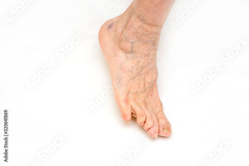 Fotografía Rheumatoid Arthitis'. .Deformation of the legs and fingers.