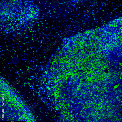 Tumour immunofluorescence IHC image of immunotherapy treatment. Tumor cells in blue attacked by immune system T cells lymphocytes in green photo