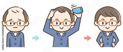 薄毛の進行　育毛　ハゲ
