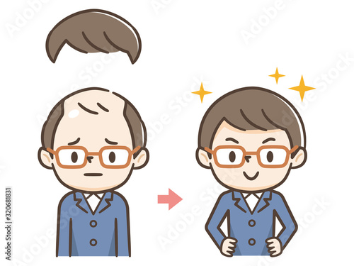 薄毛の進行　カツラ　ハゲ