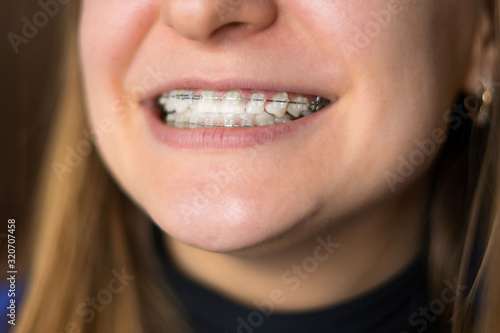 braces