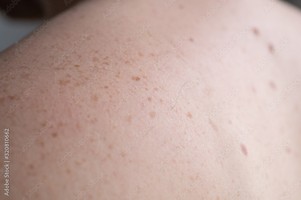Fototapeta premium Checking benign moles. Close up detail of the bare skin on a man back with scattered moles and freckles.
