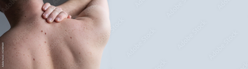 Fototapeta premium Checking benign moles. Close up detail of the bare skin on a man back with scattered moles and freckles.