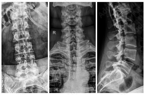 x-ray film of human spine photo