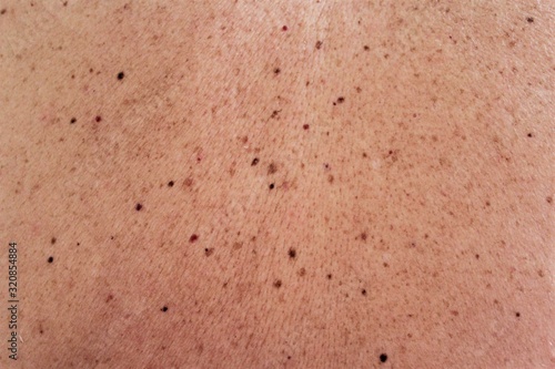 Birthmark,moles on man skin photo