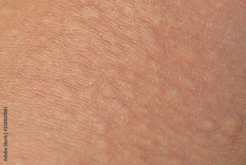 Fototapeta premium unhealthy irritated human skin texture covered with allergic bumps and blisters