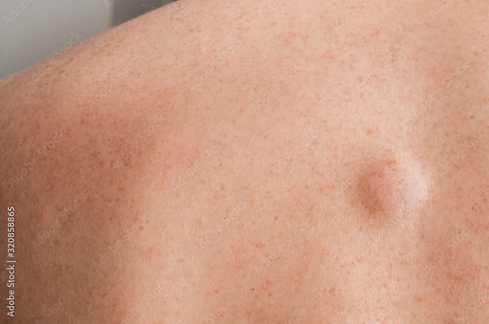 Small lipoma on the back of caucasian man Small lipoma on the back of caucasian man
