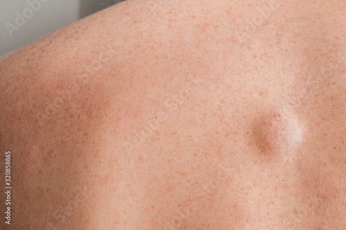 Small lipoma on the back of caucasian man photo