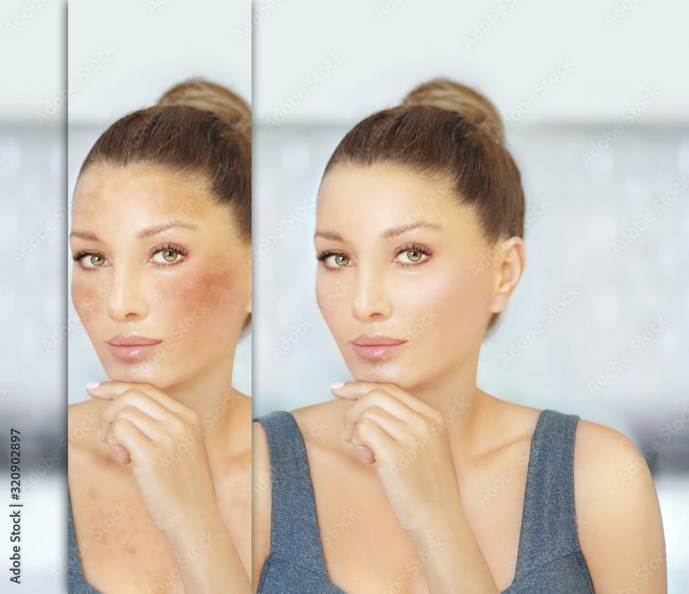 Dark spots, freckles,hyperpigmentation(melasma or chloasma) Dark spots, freckles,hyperpigmentation(melasma or chloasma)