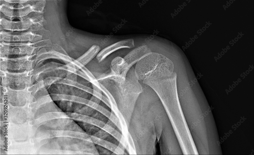 x- ray of the shoulder joint with a broken collarbone x- ray of the shoulder joint with a broken collarbone
