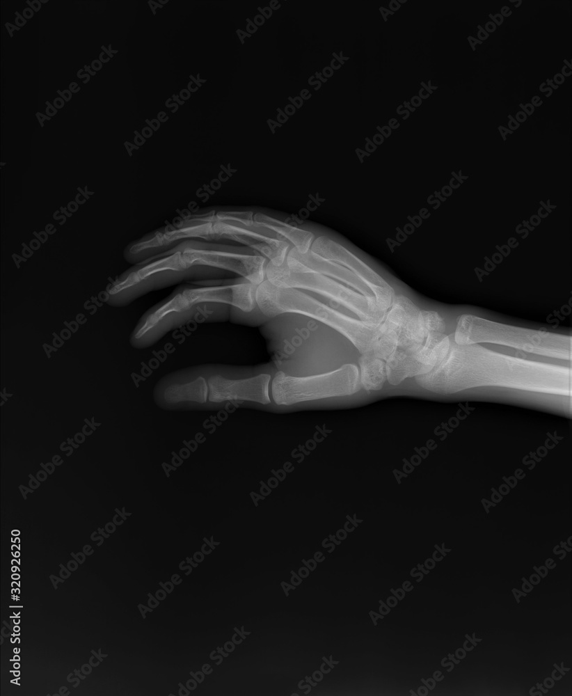 Fototapeta premium normal x-ray of the hand bones and fingers