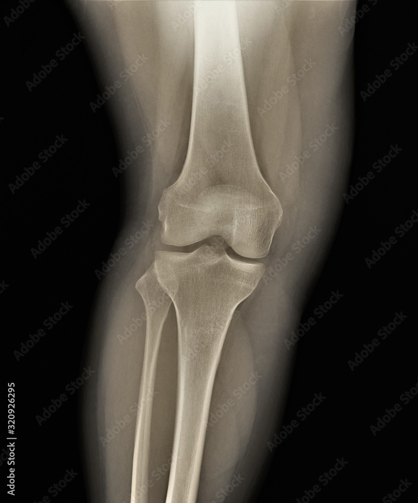 normal radiography of the knee joint in direct projection, medical diagnostics, traumatology and orthopedics normal radiography of the knee joint in direct projection, medical diagnostics, traumatology and orthopedics