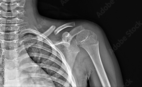 x- ray of the shoulder joint with a broken collarbone photo