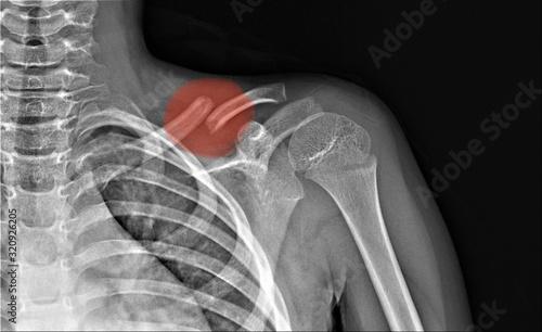 x-ray with a broken collarbone of an eight-year-old child