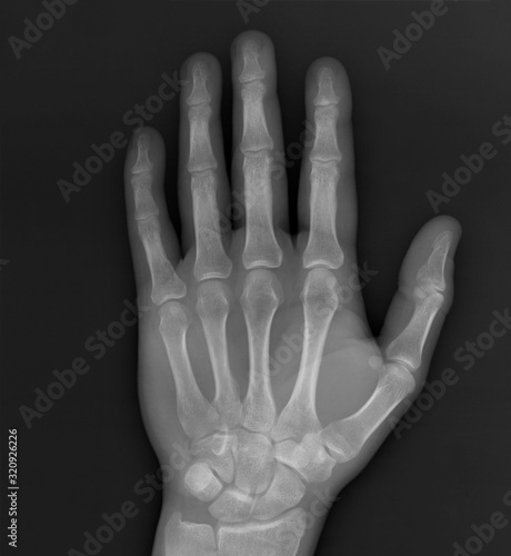 normal x-ray of the hand bones and fingers