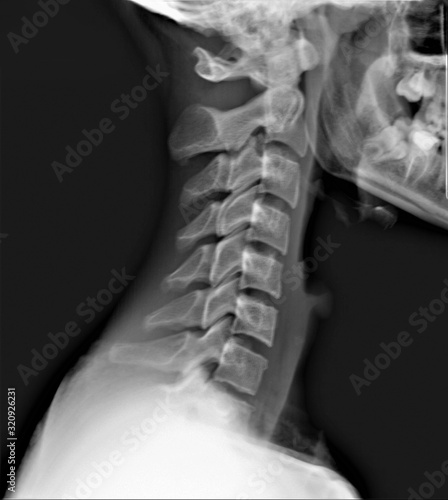 x-ray of the cervical spine