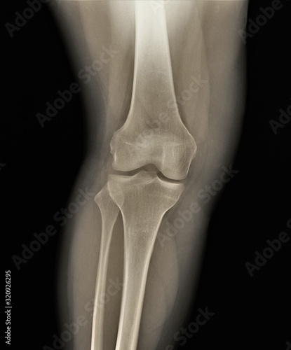 normal radiography of the knee joint in direct projection, medical diagnostics, traumatology and orthopedics