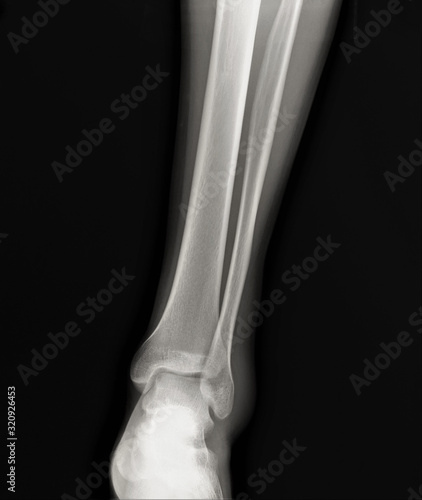 normal radiography of the ankle joint in the lateral projection