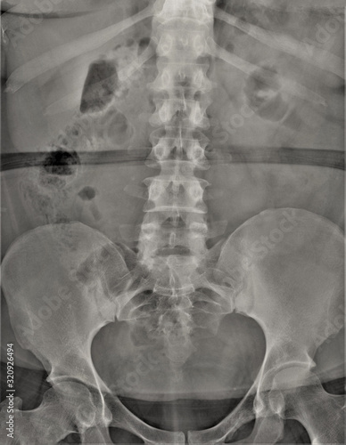 x-ray of the abdominal cavity and pelvis in direct projection, medical research,urography photo