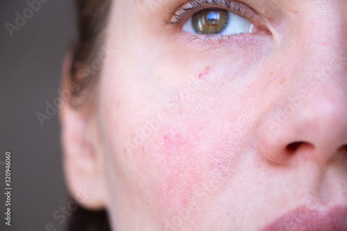 Fotografía the girl has red capillaries on her face