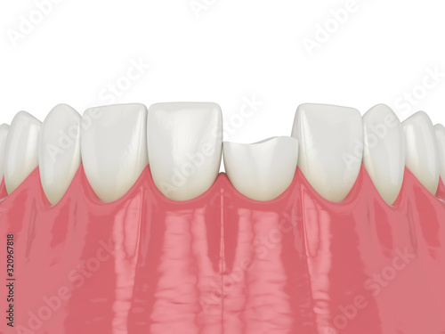 Foto 3d render of lower jaw with broken incisor tooth
