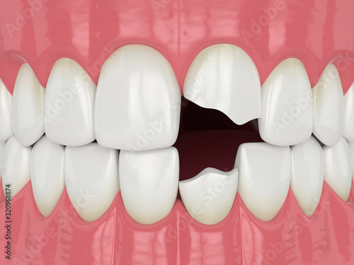 Fotografija 3d render of jaw with broken incisors teeth