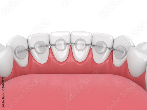 3d render of dental bonded retainer on lower jaw