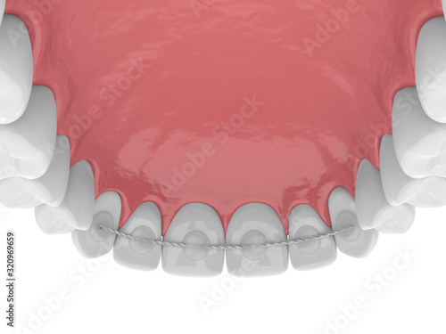 3d render of dental bonded retainer on upper jaw