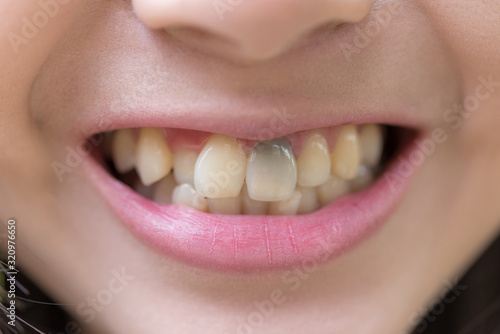 Dead tooth ,teeth discoloration ,teeth change color,