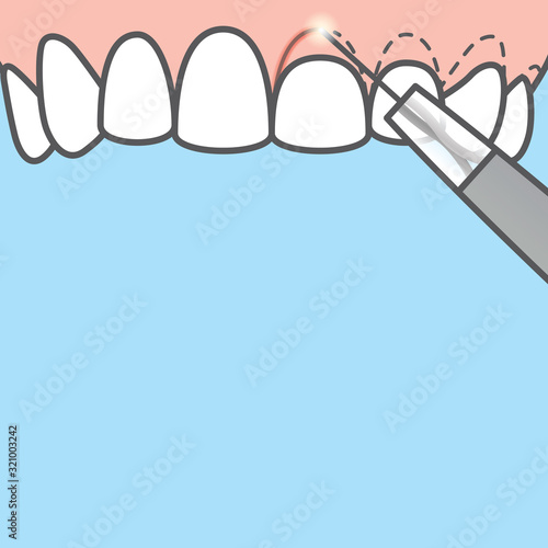 Blank banner Upper Gingivoplasty & Gingivectomy electrosurgery cut gum off illustration vector on blue background. Dental concept.