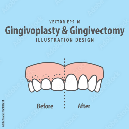 Compare upper teeth Gingivoplasty & Gingivectomy surgery before and after electrosurgery cut gum off illustration vector on blue background. Dental concept.