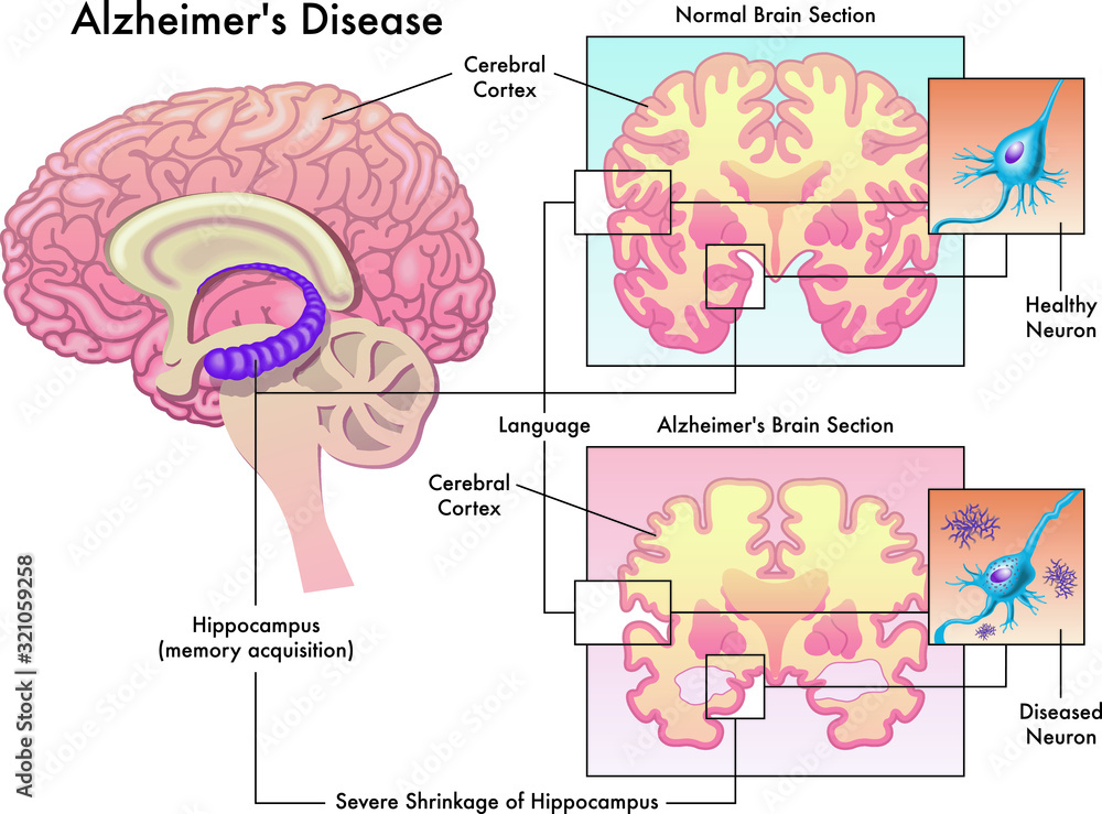 Fototapeta premium Medical illustration of Alzheimer`s disease isolated on white.