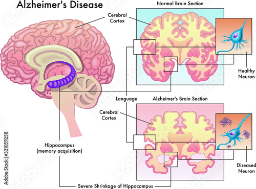 Medical illustration of Alzheimer`s disease isolated on white.
