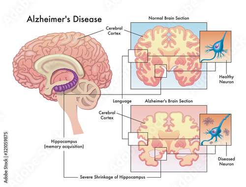Medical illustration of Alzheimer`s disease isolated on white.