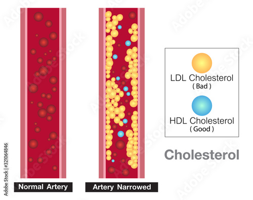 Cholesterol in artery, health risk , vector design