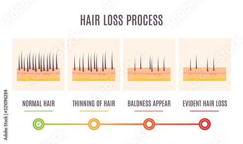 Hair loss process infographic of scalp close up with receding hair follicles. Skin cross-section medical diagnostics diagram. Alopecia treatment and transplantation concept. Vector illustration.