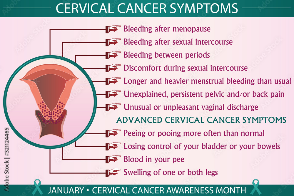 Cervical cancer symptoms infographic vector illustration. Health,  healthcare, and january cervical cancer awareness month concept for  presentation, brochure, banner. Eps 10 format, printable colors. Stock  Vector