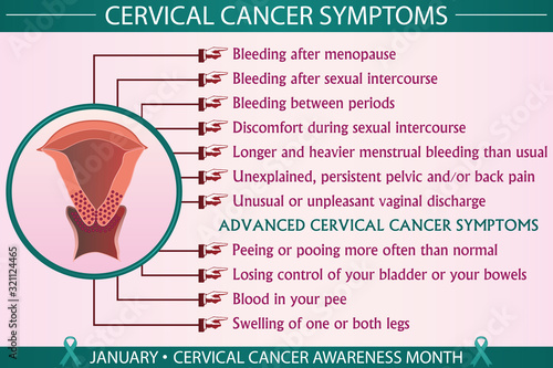 Cervical cancer symptoms infographic vector illustration. Health, healthcare, and january cervical cancer awareness month concept for presentation, brochure, banner. Eps 10 format, printable colors.