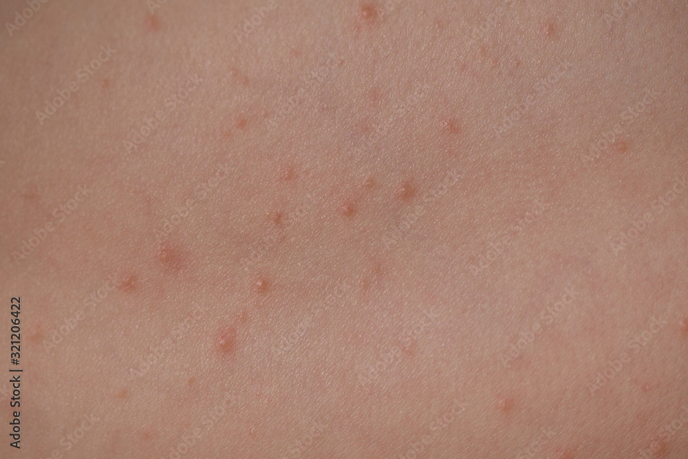 Large spots and pimples acne on the body are sweating. Viral eczema