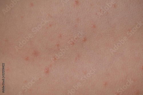 Large spots and pimples acne on the body are sweating. Viral eczema, chicken pox or rubella, reaction to enterovirus.