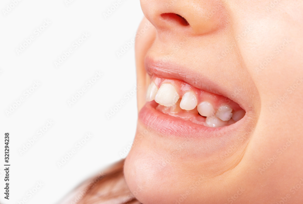 Obraz premium child mouth with permanent gapped teeth