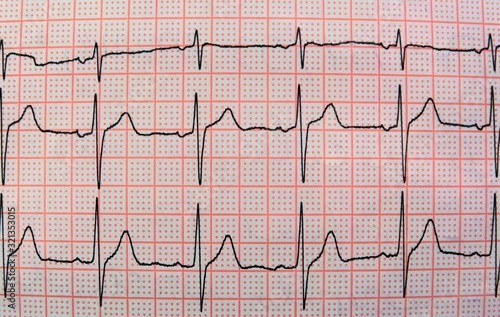 cardiogram EKG with the heartbeat
