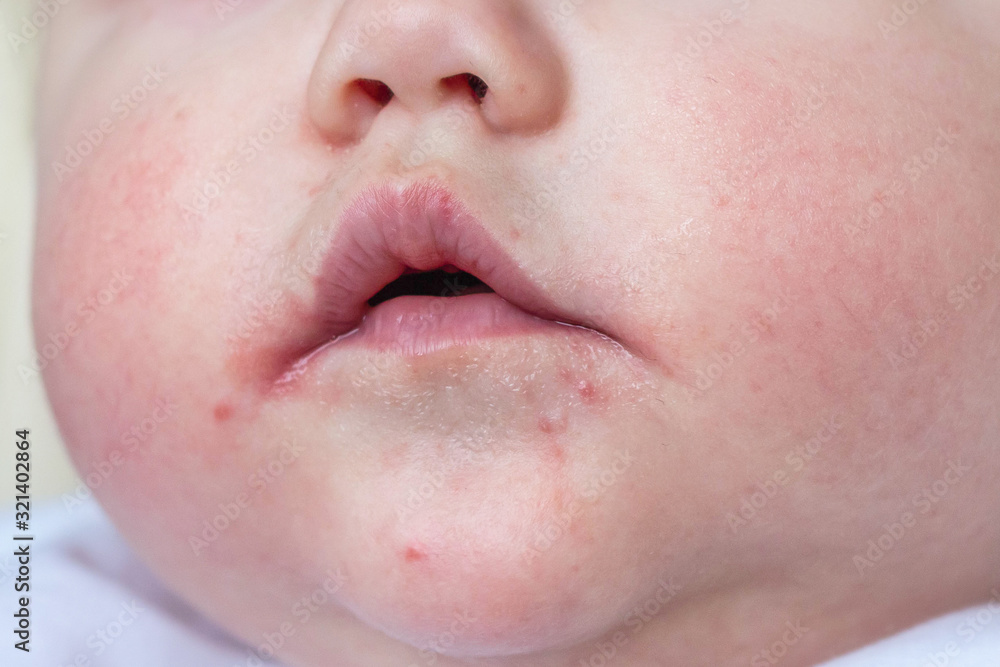 Atopic Dermatitis. Skin rash on baby face. Allergy concept. Atopic Dermatitis. Skin rash on baby face. Allergy concept.