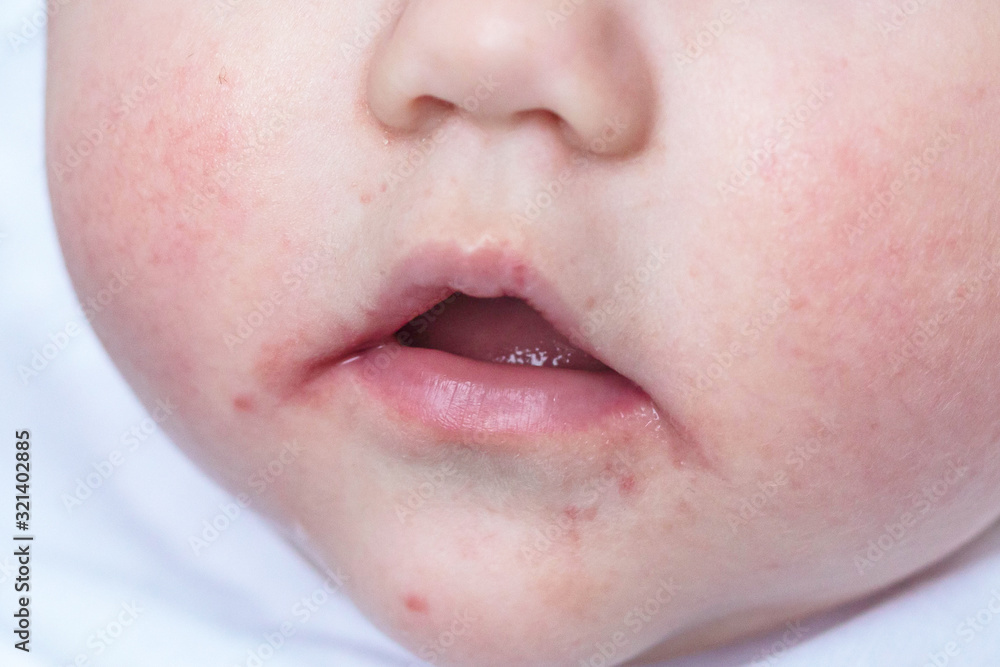 Atopic Dermatitis. Skin rash on baby face. Allergy concept. Atopic Dermatitis. Skin rash on baby face. Allergy concept.