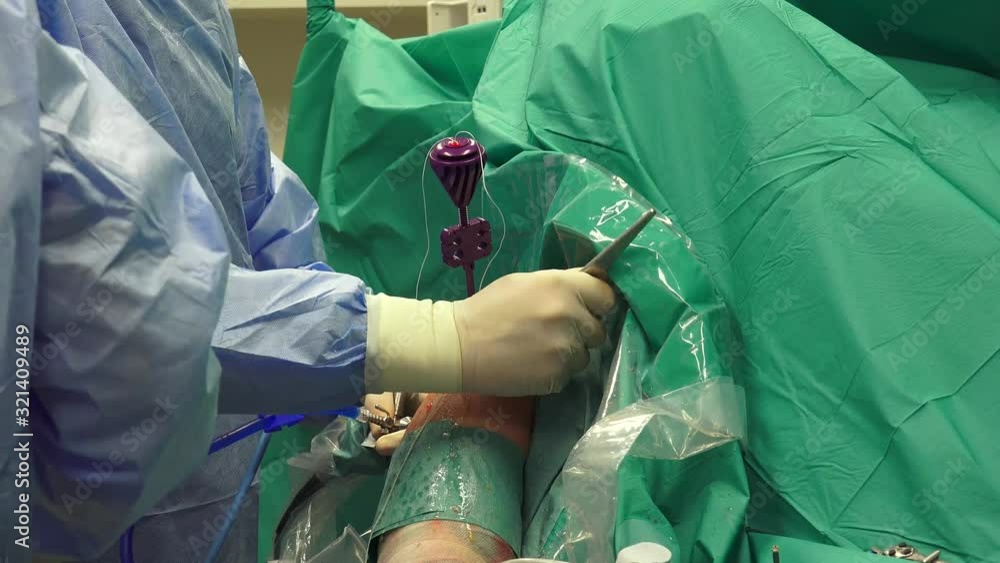 Shoulder arthroscopy is surgery that uses a tiny camera called an